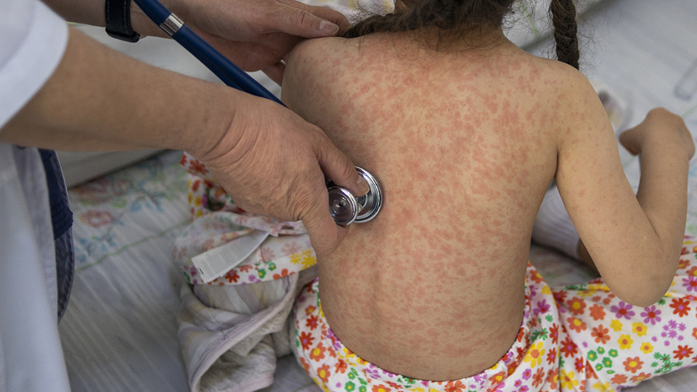 caso-de-sarampion-en-nina